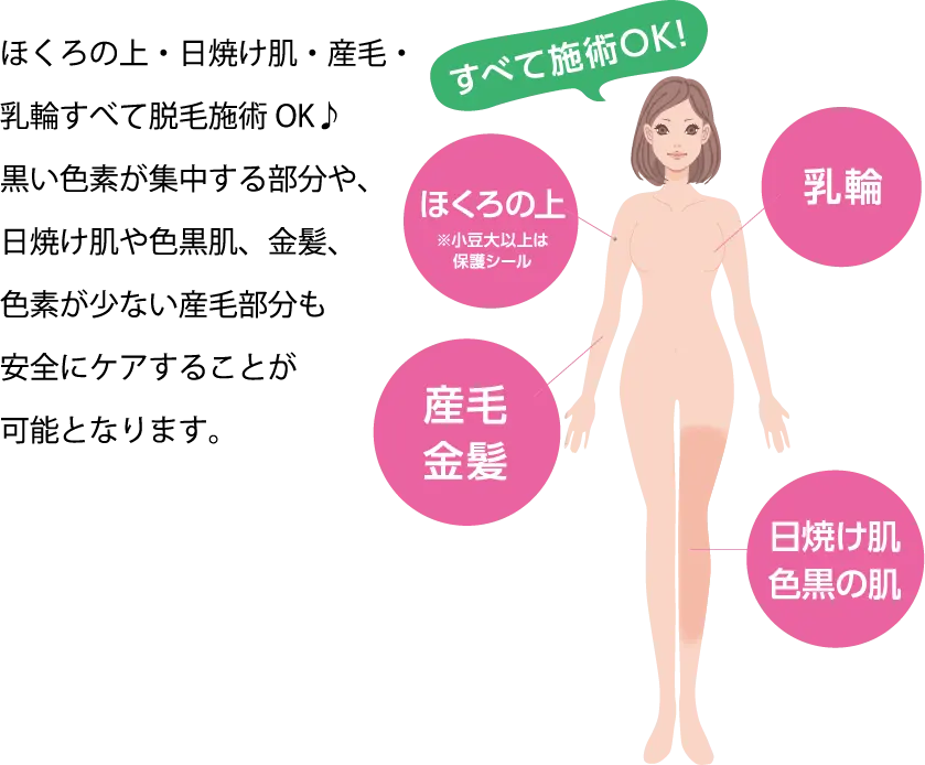 ほくろの上・日焼け肌・産毛・乳輪すべて脱毛施術OK♪黒い色素が集中する部分や、
          日焼け肌や色黒肌、金髪、色素が少ない産毛部分も安全にケアすることが可能となります。